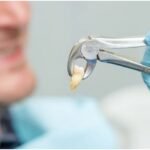 What Happens to Your Jaw After a Tooth Extraction