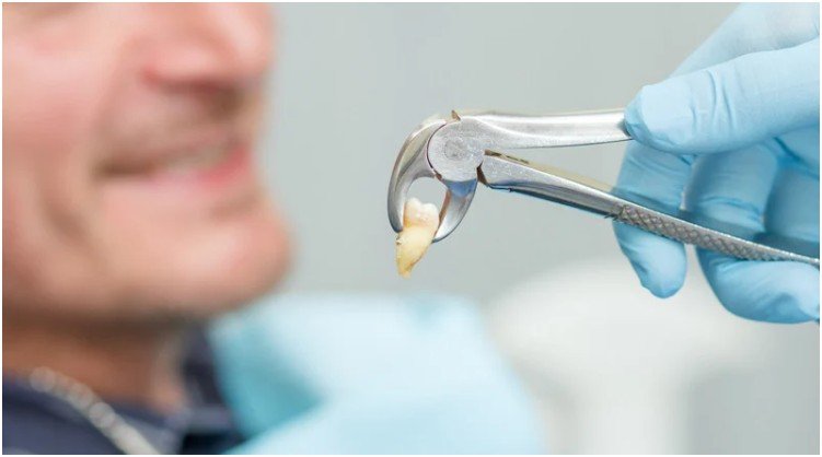 What Happens to Your Jaw After a Tooth Extraction?