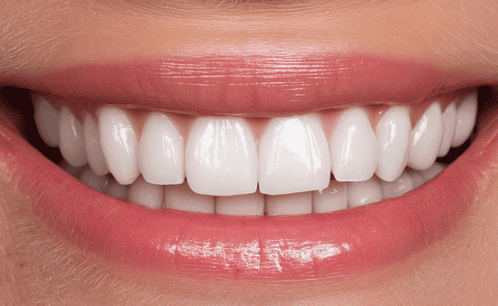 Arch Width and the Buccal Corridor