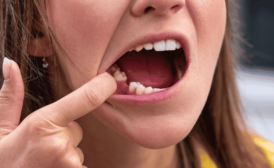 The Cost of Ignoring a Missing Tooth: Why You Shouldn’t Wait to Replace It
